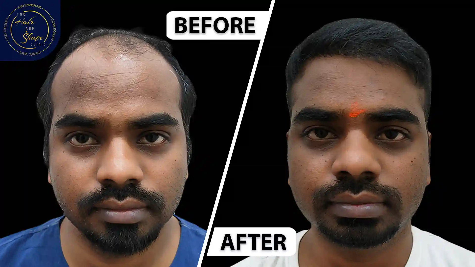 Hair Transplant result34